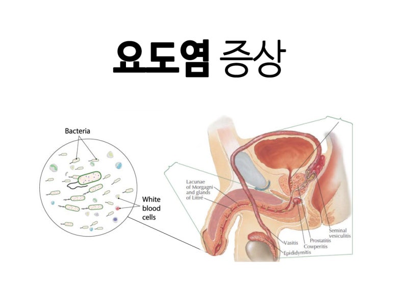 남자요도염 증상 : 비임균성/임균성 나누어 살펴보기 : 네이버 블로그