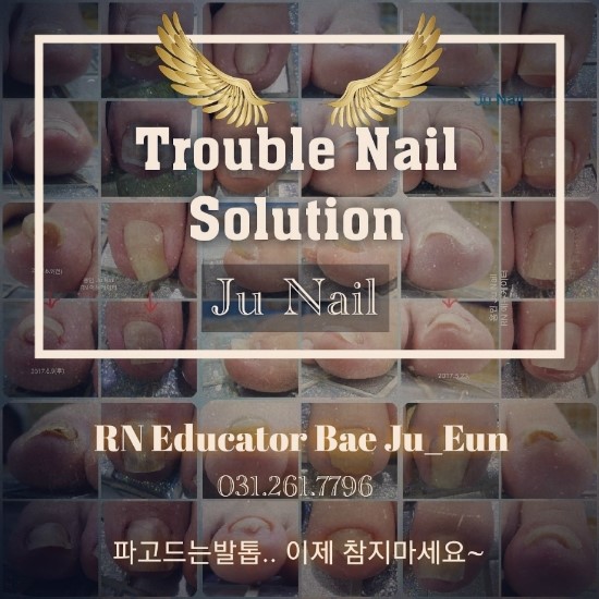 조갑감입증.내향성발톱.내성발톱.파고드는발톱/분당용인수원수지보정동백죽전동/주네일 조갑감입증.내향성발톱.내성발톱.파고드는발톱/분당용인수원수지보정동백죽전동/주네일
