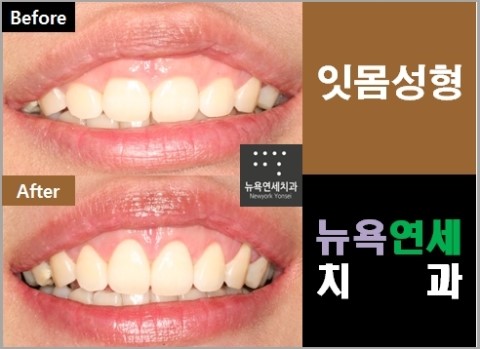  노출 되는 잇몸이 큰 경우 잇몸성형으로 교정이 가능합니다.