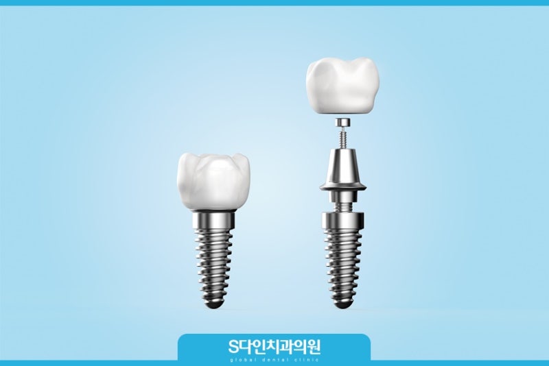 치과위생사 일일오스템MS임플란트(앞니부일체형임플란트) 공부