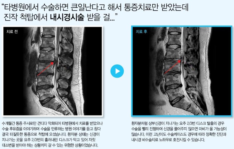 허리디스크 수술치료 어떤 경우에