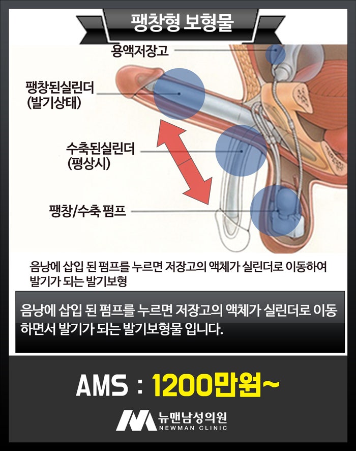 굴곡형, 팽창형 발기부전 보형물 선택의 기준은?