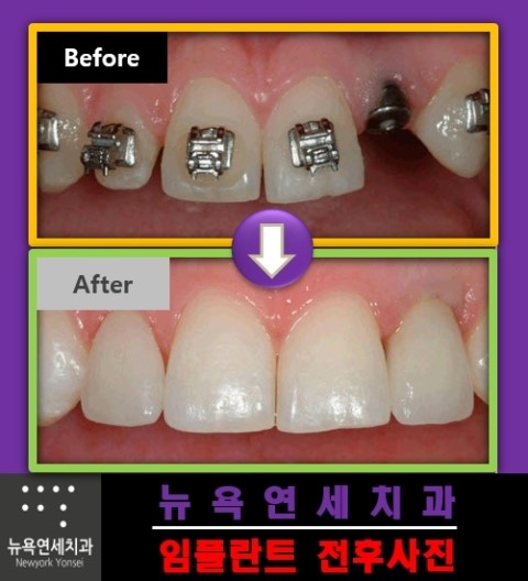 치아를 뽑고 임플란트 치아로 자연치아의 기능을 회복 할 수 있습니다.