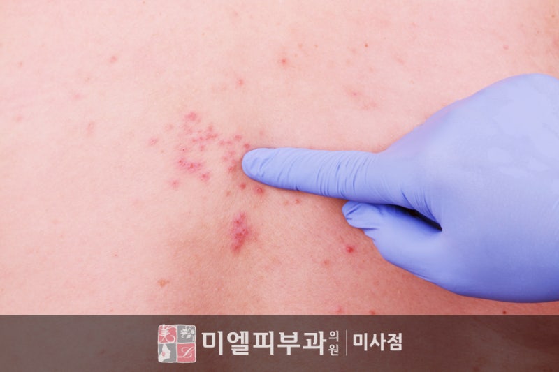 독산정형외과 대상포진 초기증상 감기 걸렸다고 생각하면 9