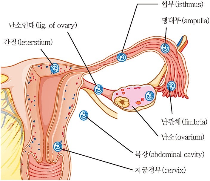 자궁외 임신증상의 원인이 되는 임플란트 (w. 수술방법)