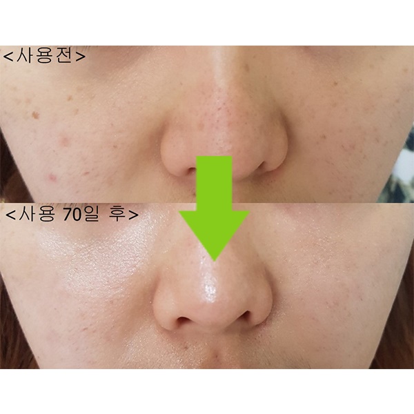 얼굴 색소침착으로 관리가 필요한 지금 류스파 3