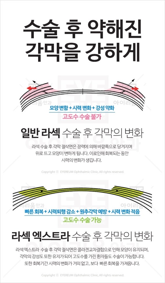 [아이리움안과]라섹엑스트라란?