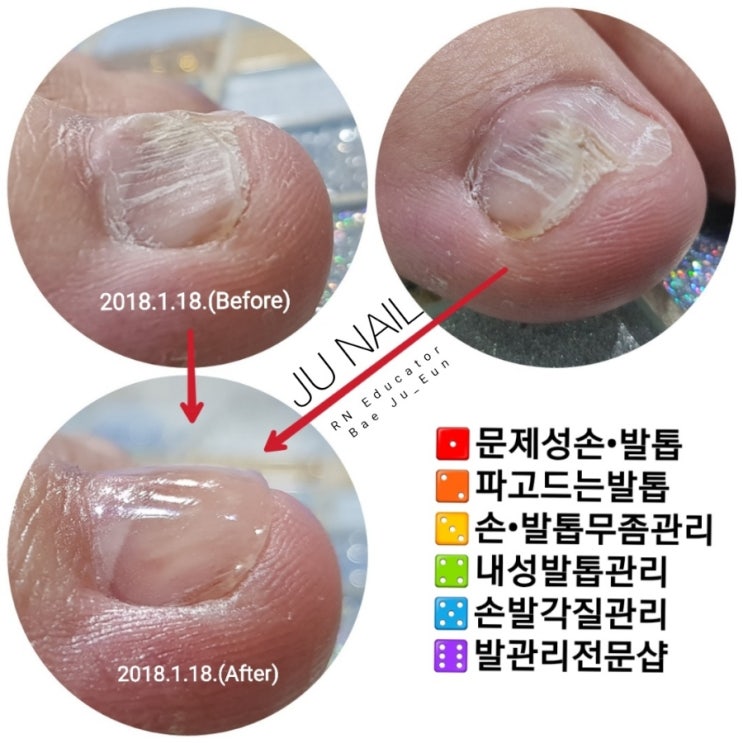 발톱세로능선과발톱갈림/분당용인수원수지보정동백죽전동/주네일/파고드는발톱 발톱세로능선과발톱갈림/분당용인수원수지보정동백죽전동/주네일/파고드는발톱