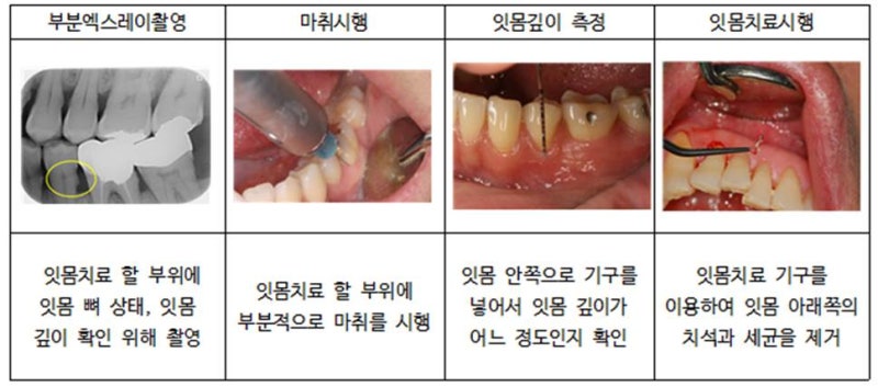잇몸 제거의 원인과 치료 방법