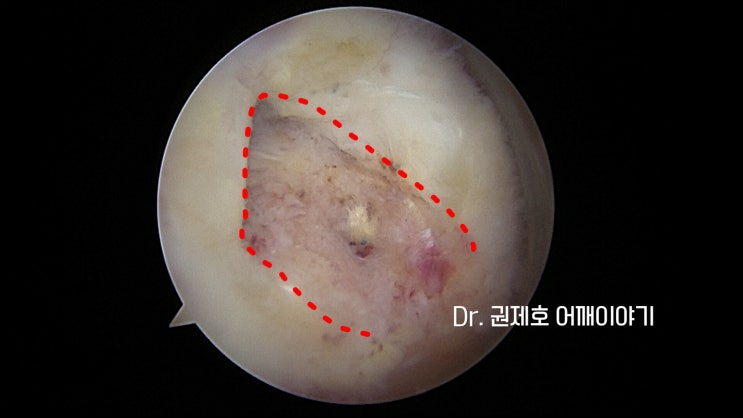  회전근개재파열 봉합술 firm 견고하게