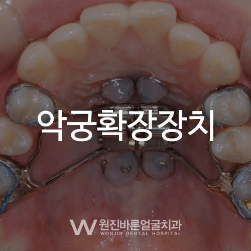 치열교정의 신비로운 효과 외눈교정, 악궁확장장치를 이용한 덧니교정 리뷰