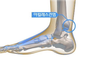 논현역신경외과, 아킬레스건에 통증이 5