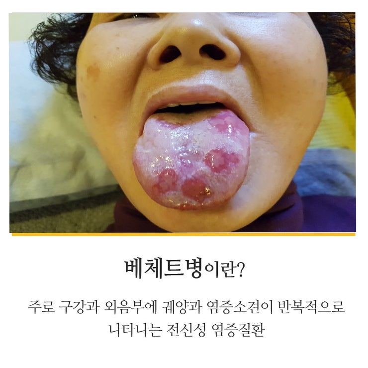 베체트병 원인 30년 전부터 대학병원(치경 혀 입술 자궁 항문염증 우울증 불면증 위장 등 소화기관 두통) 치료받았는데/코로나 백신 부작용 2