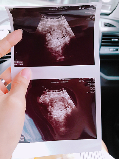 임신확인 금새 입덧 시작(2017.05~임신 11주차)