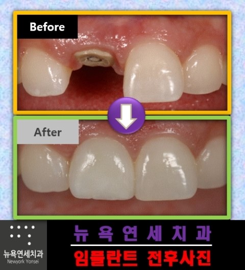  앞니 발치와 동시에 즉시 임플란트 시술을 한 전후 사례