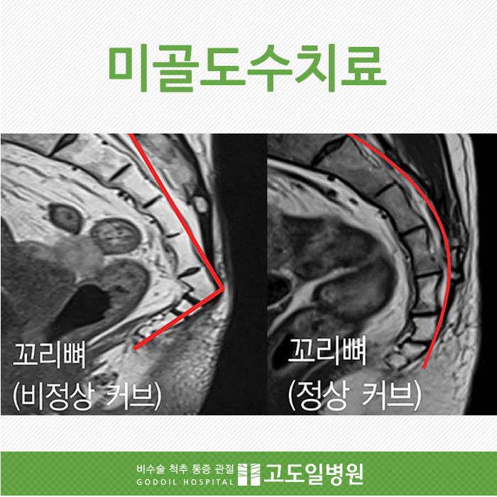 강남도수치료,외 골프 엘보우 치료방법이 있을까요? <필독>