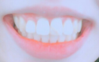  [교정 630] 15번째 월치료, 클리피씨 장치제거 및 투명교정 전환(덧니교정/치아교정일기/비발치교정/강남아미치과/클리피씨교정/투명교정)