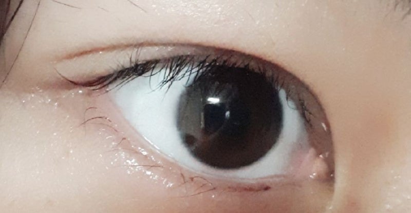 성인 안검내반증 수술후기 대학병원 소견서 검진진단서 의료보험 적용 수술비용 눈의 변화사진 8
