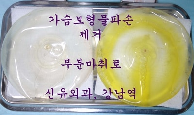 생리식염수백파손(변색됨)으로 가슴보형물제거(부분마취)하신 분
