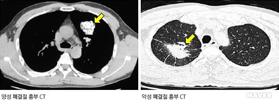 고립성폐결절 고립성 폐결절과 다발성 폐결절
