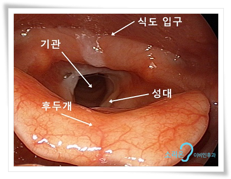 인후염제 인후염제 은교산(임펙신) 용각산 효능: 역류성 인후염증상 진해거담약