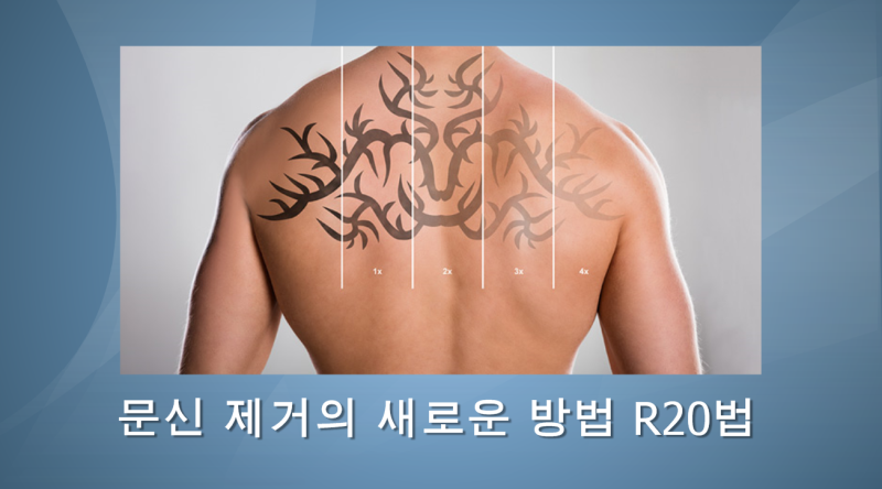 (문신치료) 헤나,멘디 "검은 헤나로 인한 접촉성 피부염" – 가락동 송파동 석촌동 헬리오시티피부과