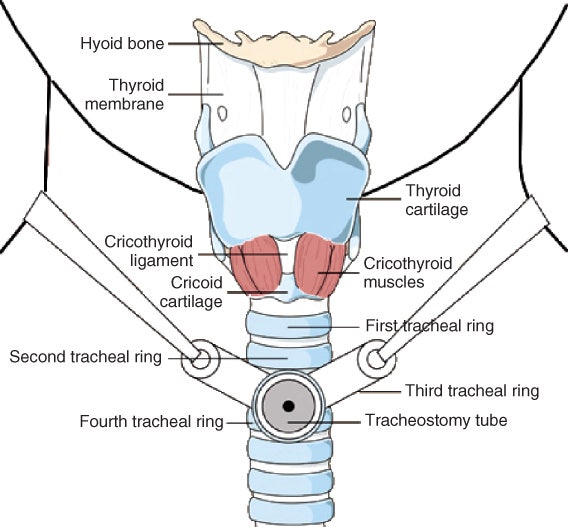 기관절개술, 기관절개관(Tracheostomy tube, portex, Tracoe) 목적, 관리, 종류, 간호, 커프 : 네이버 블로그 기관절개술, 기관절개관(Tracheostomy Tube, Portex, Tracoe) 목적, 관리, 종류, 간호, 커프 : 네이버 블로그