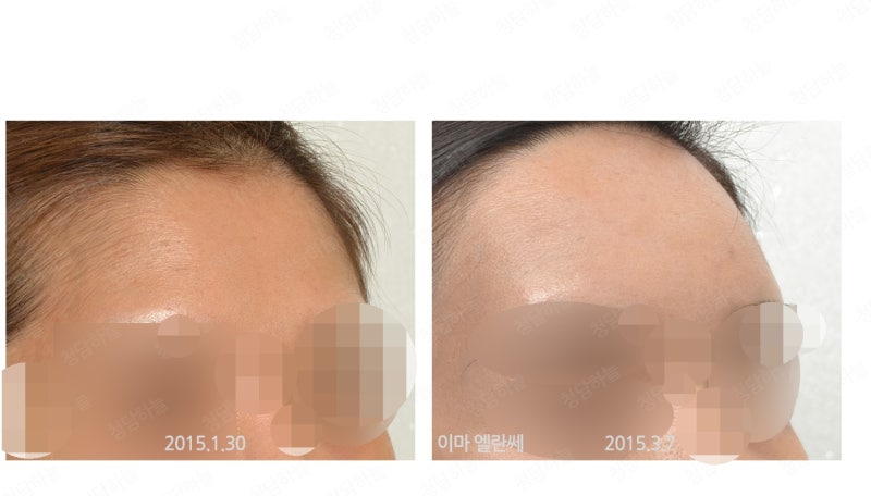 이마필러 엘란쎄 붓기 빠진후 - 40 : 네이버 블로그 이마필러 엘란쎄 붓기 빠진후 - 40 : 네이버 블로그