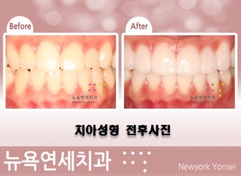  연예인처럼 앞니를 치아성형 하고 싶다면...