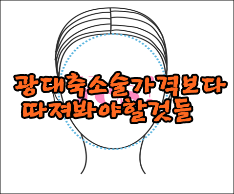 광대축소술가격보다 따져봐야할것들