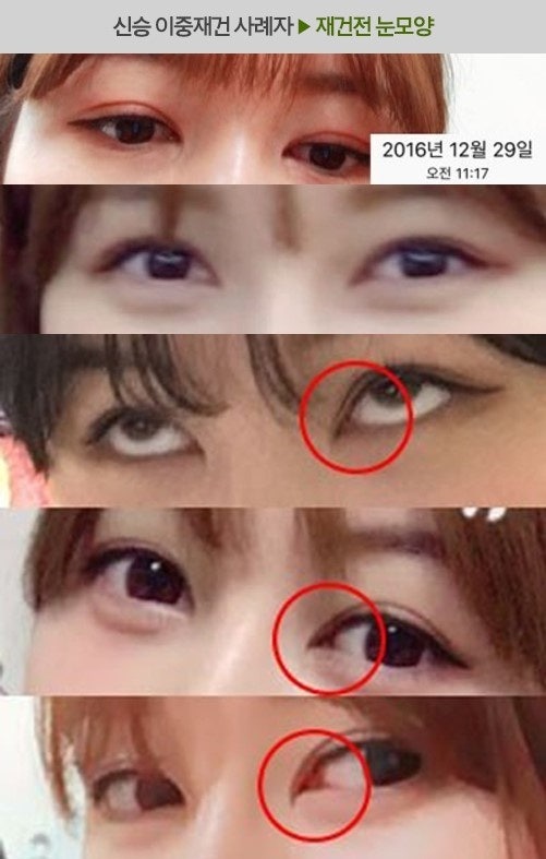 앞트임 복원 수술(앞트임 재건) 3