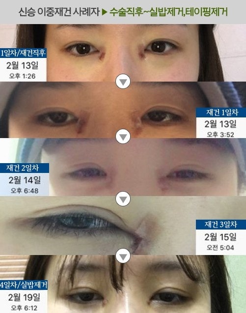 앞트임 복원 수술(앞트임 재건)