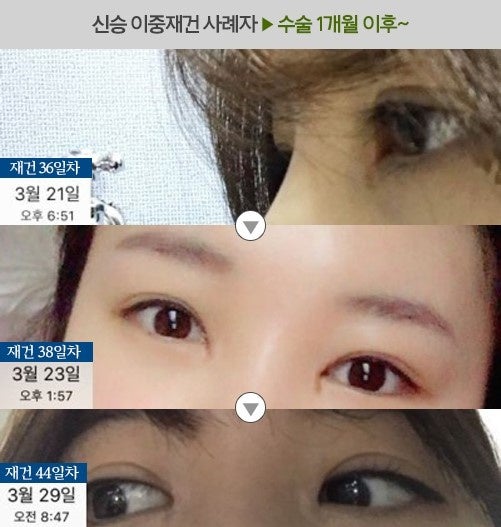 앞트임 복원 수술(앞트임 재건) 7