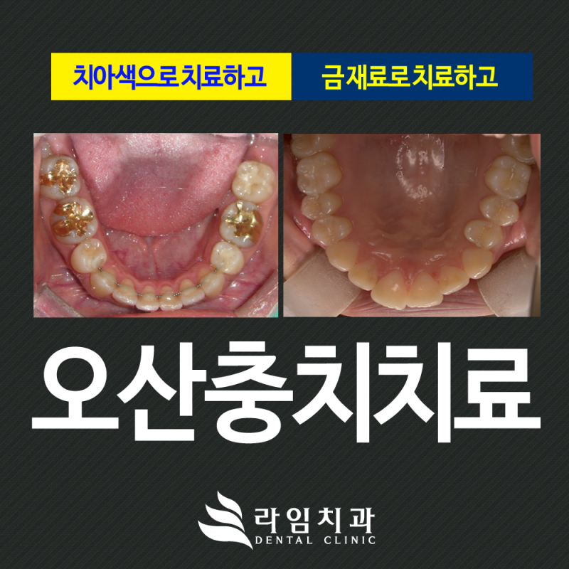 오산 어금니 신경치료와 씌우기