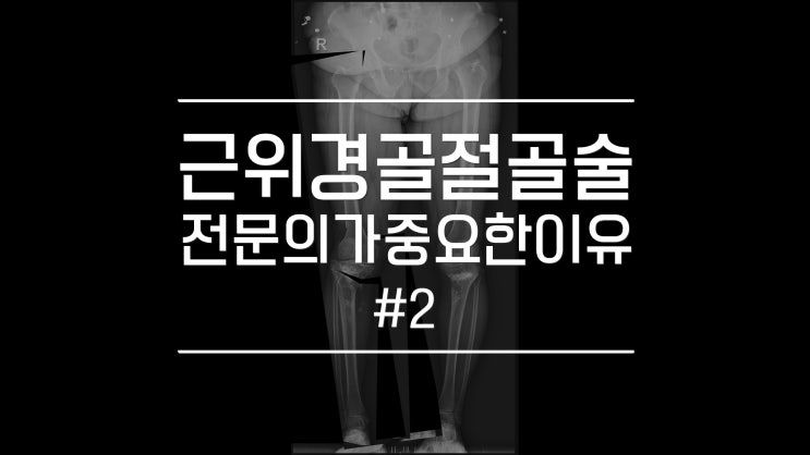 근위경골 절골술 전임에게 받아야 하는 이유 그 두 번째 이야기