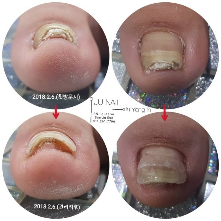 엄지발톱골절후/분당용인수원수지보정동백죽전동/주네일/파고드는발톱 엄지발톱골절후/분당용인수원수지보정동백죽전동/주네일/파고드는발톱
