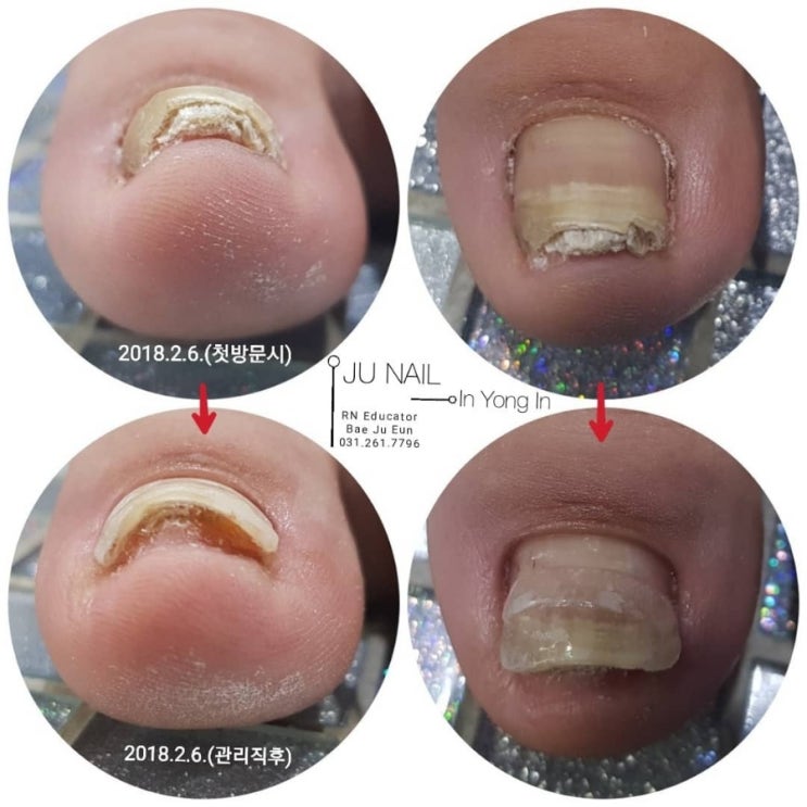 엄지발톱골절후/분당용인수원수지보정동백죽전동/주네일/파고드는발톱