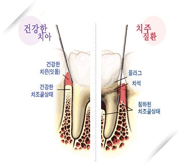 동래구 치과 치주질환이 전신 건강에 영향을 준다고? 10