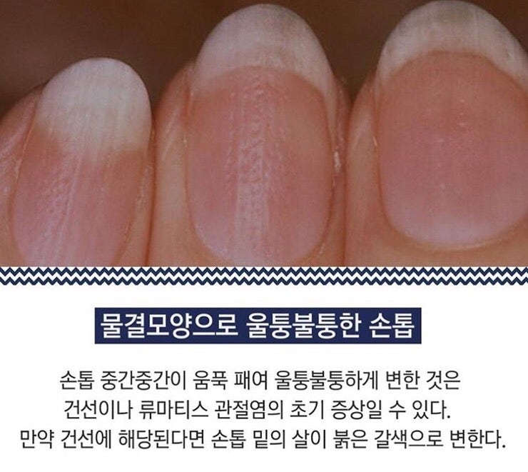 손톱이 울퉁불퉁 백반으로 갈라져서 이렇게 해요!