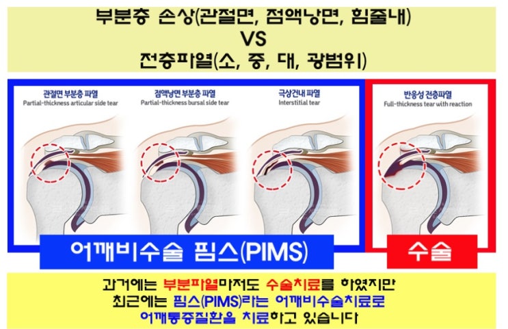 왼쪽어깨통증 치료방법 어렵게 생각하지
