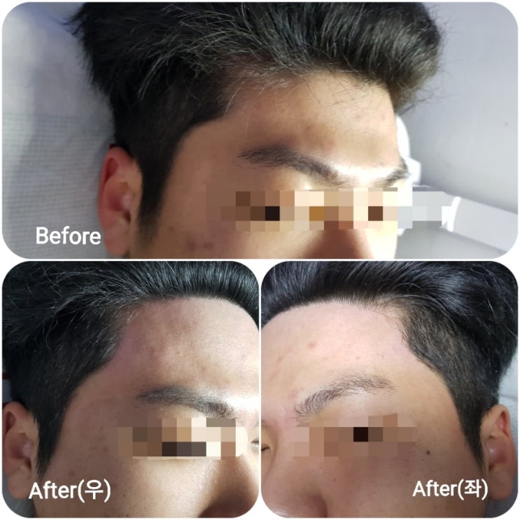 남자헤어라인왁싱/분당용인수원수지동백보정동죽전동/주네일 남자헤어라인왁싱/분당용인수원수지동백보정동죽전동/주네일