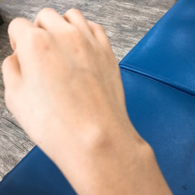 손목결절종 수술 대신 손목보호대로 나은 후기 12