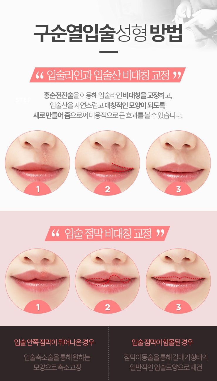 구순구개열 유전 언청이 유전 적절한 수술 시기는?! : 네이버 블로그