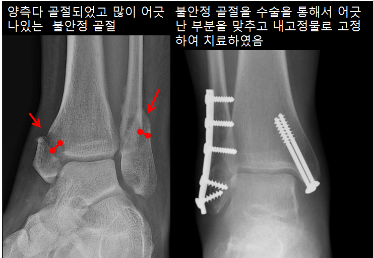 발목의 개방성 골절의 수술적 9