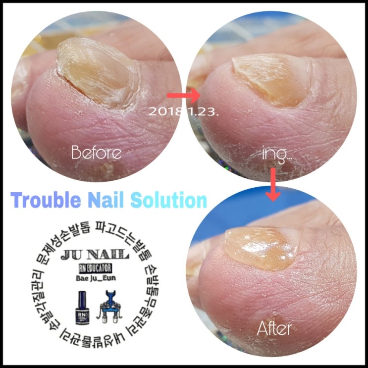 비정상적으로두꺼워진발톱/분당용인수원수지보정동백죽전동/주네일/파고드는발톱 비정상적으로두꺼워진발톱/분당용인수원수지보정동백죽전동/주네일/파고드는발톱
