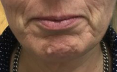 [안산보톡스] 턱끝 침샘 사각턱 보톡스  - 월피동 피부