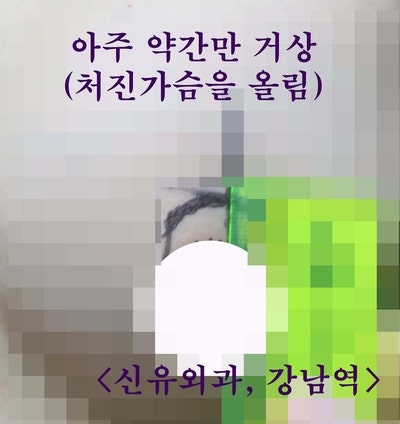 배꼽 생리식염수백을 부분마취로 가슴보형물교체하며 처진가슴거상술, 맘모톰까지 동시에