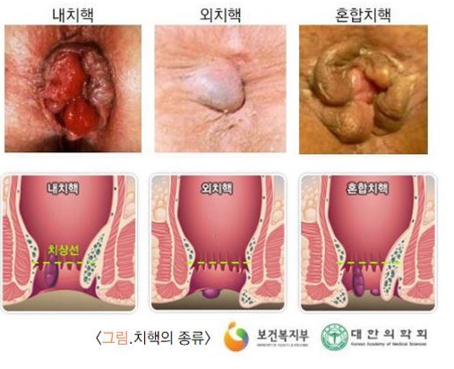 치질 치료(내치핵, 외치핵, 혼합치핵)