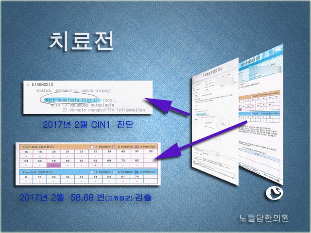 자궁경부이형성증 1단계 치료 전