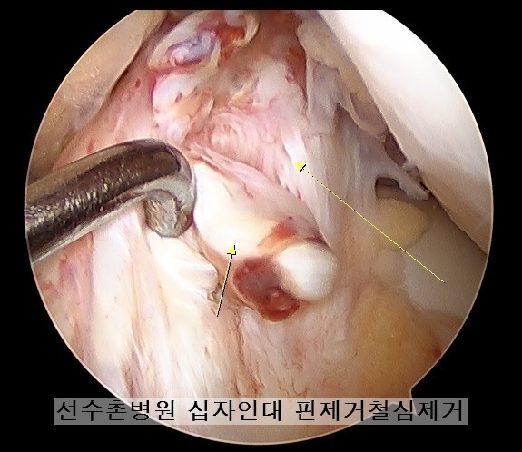 무릎 수술 후 핀제거(전방십자인대 & 4